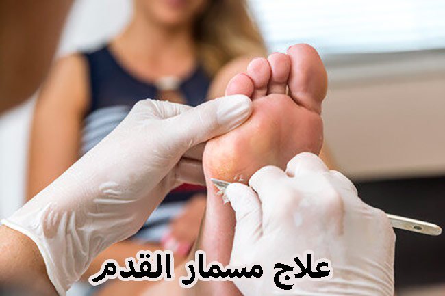 مسمار القدم أسبابه وعلاجه: كيفية علاج مسمار القدم من قبل الأطباء
