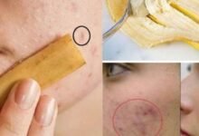 فوائد قشر الموز