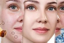 كيف اتخلص من الحبوب تحت الجلد