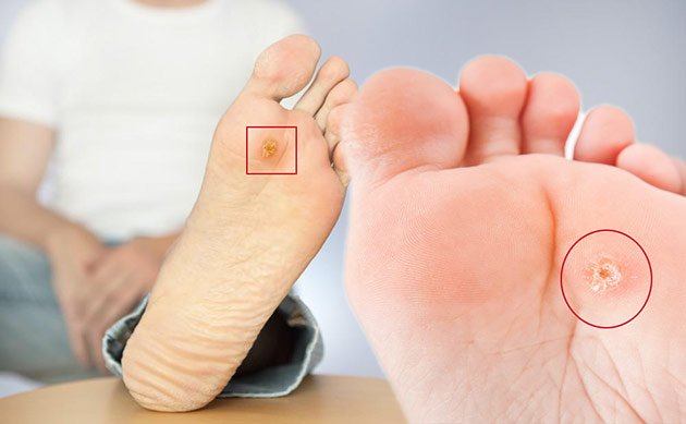 مسمار القدم أسبابه وعلاجه