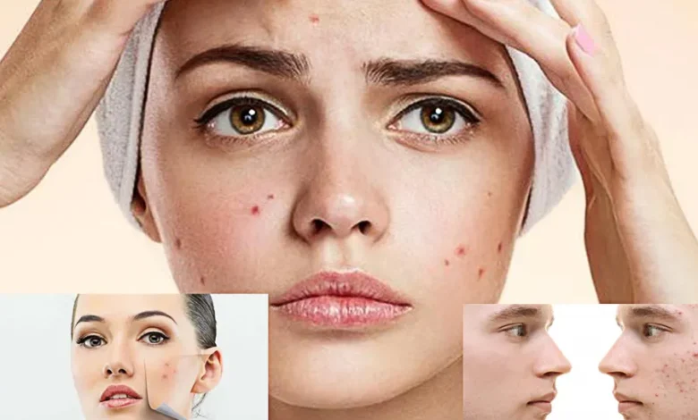 أنواع الحبوب في الوجه تظهر على بشرة فتاة
