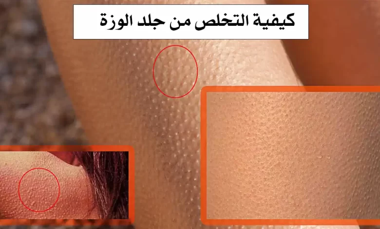 كيفية التخلص من جلد الوزة