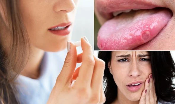 لسان متقرح نتيجة نقص فيتامين B12
