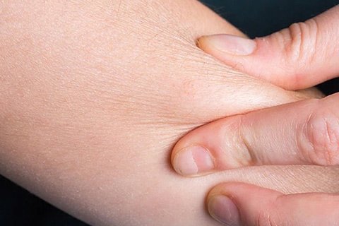 جفاف الجلد واحد من عدة أمراض يسببها مكيف الهواء