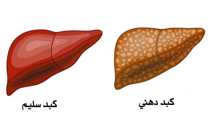 مرض الكبد الدهني
