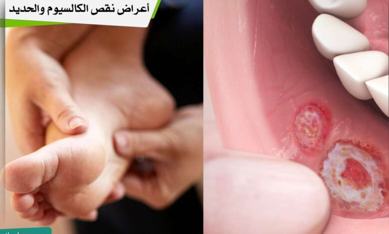 أعراض نقص الكالسيوم والحديد