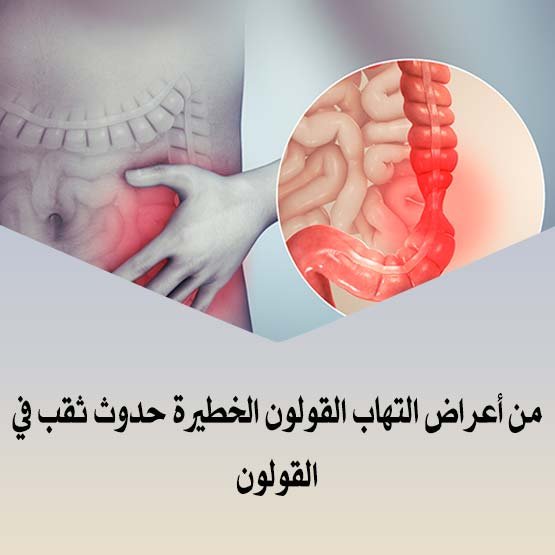 من أعراض التهاب القولون الخطيرة حدوث ثقب في القولون