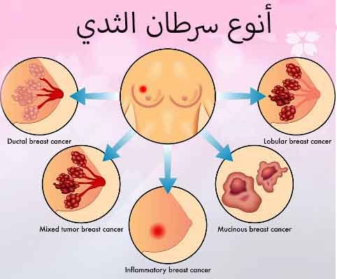 ما هي أنواع سرطان الثدي