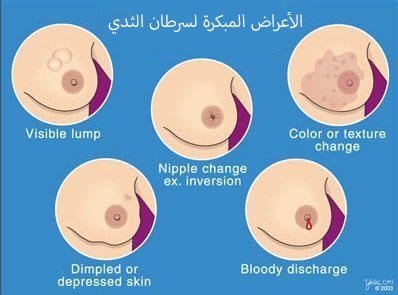 الأعراض المبكرة لسرطان الثدي التي تشير الى الإصابة بالمرض