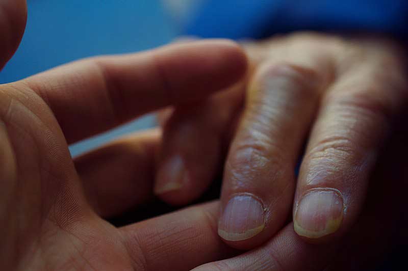 تغير لون وشكل الأظافر من علامات متاعب القلب